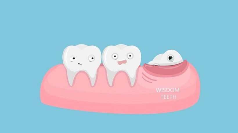 How to tell if wisdom teeth are coming in?